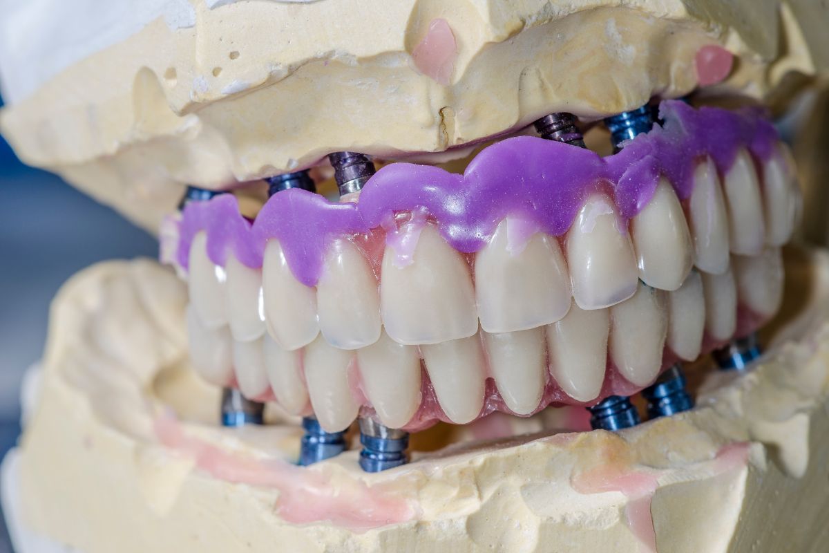 Prótese de Porcelana em Moema São Paulo — Forma Odontologia Digital