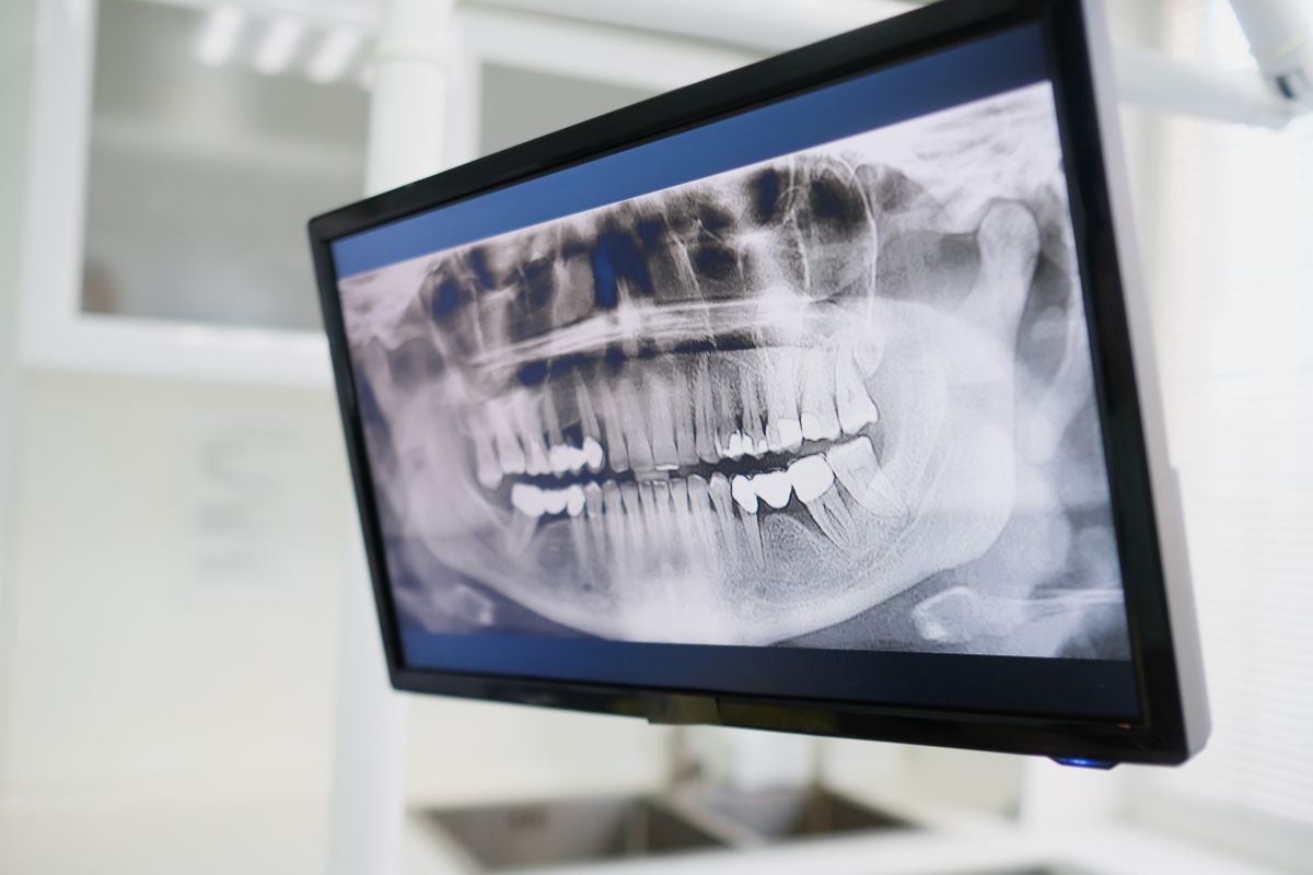 Raio-X Periapical Digital — Forma Odontologia Digital Moema São Paulo