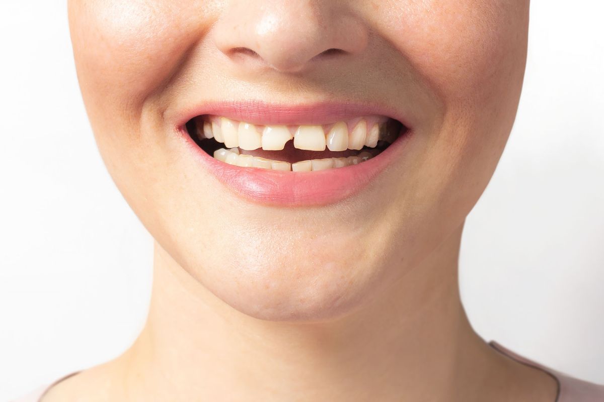 Tratamento para Dente Quebrado em Moema São Paulo — Forma Odontologia Digital