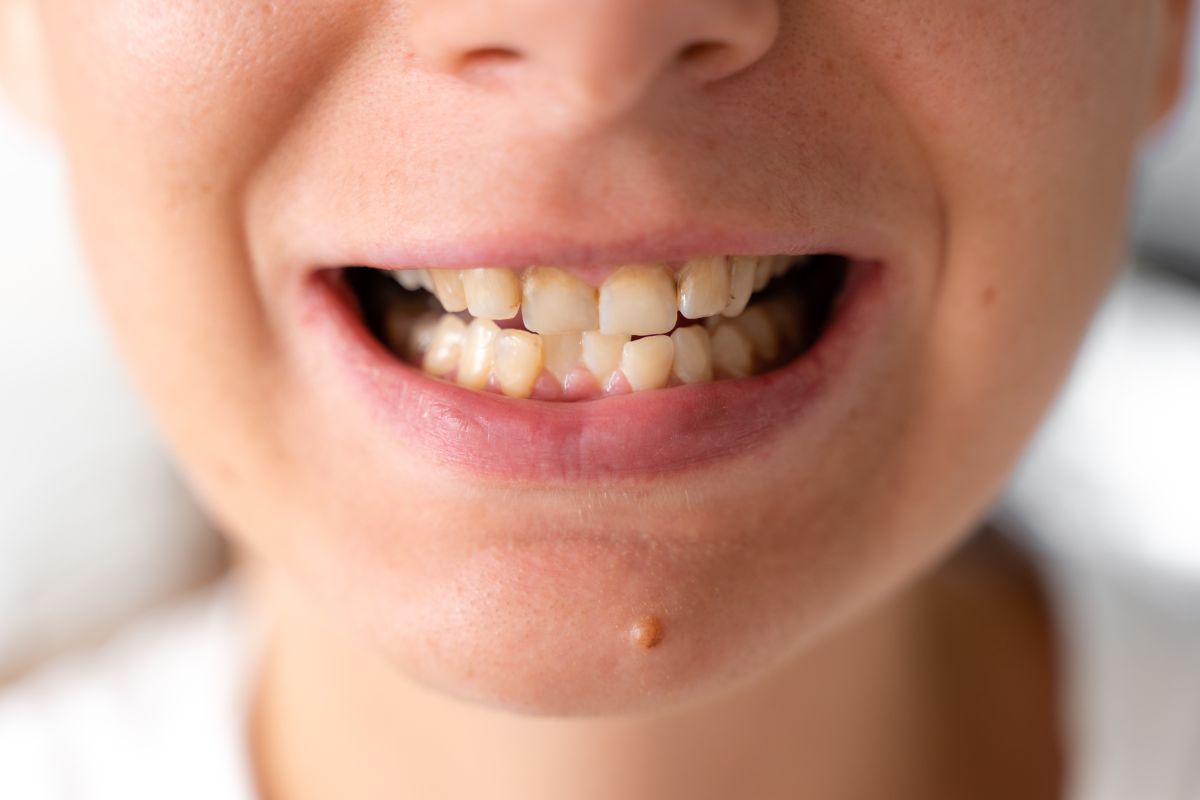 Tratamento para Dentes Tortos em Moema São Paulo — Forma Odontologia Digital