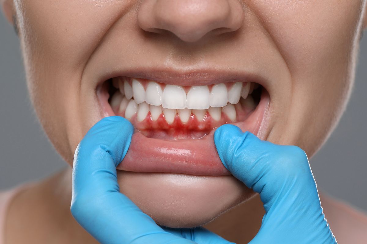 Tratamento para Sangramento na Gengiva — Forma Odontologia Digital Moema São Paulo