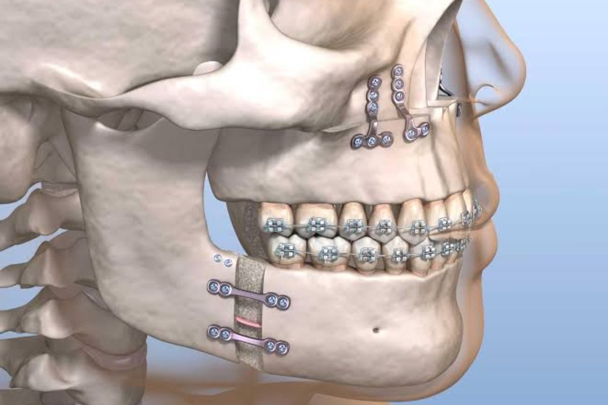 Cirurgia Ortognática em São Paulo — Forma Odontologia Digital